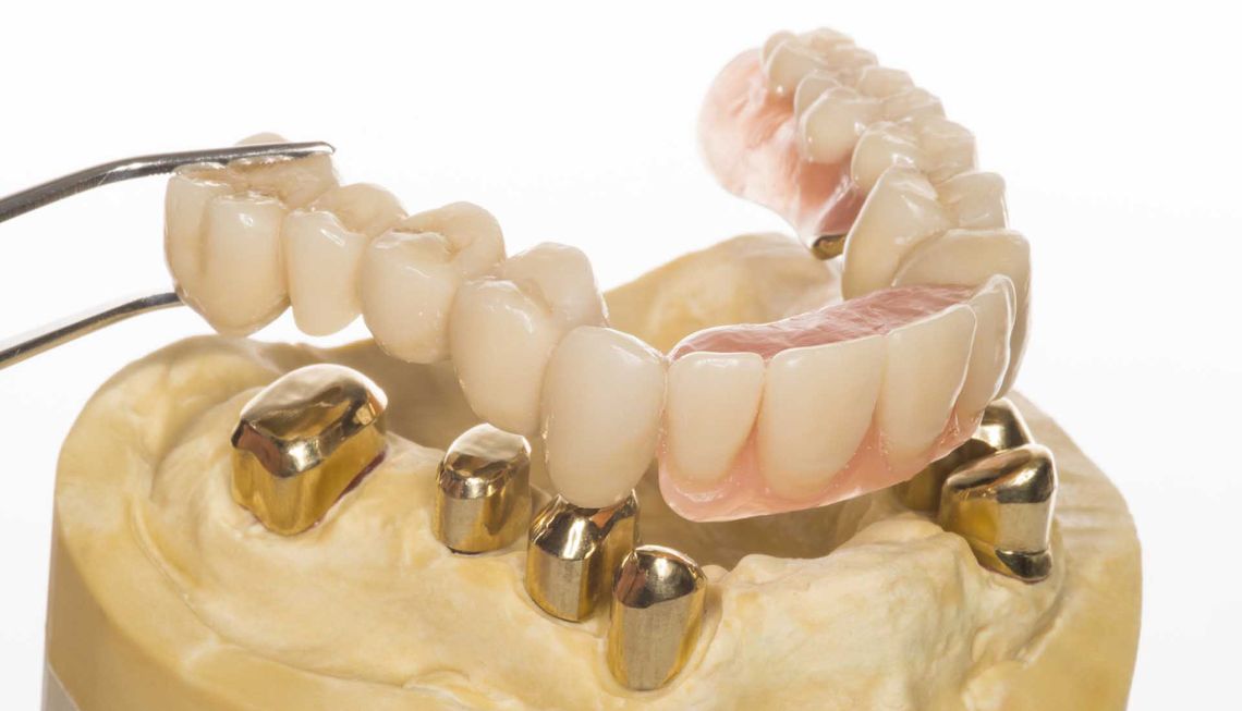 Zahnprothese und Zahnersatz in Höfen bei Reutte